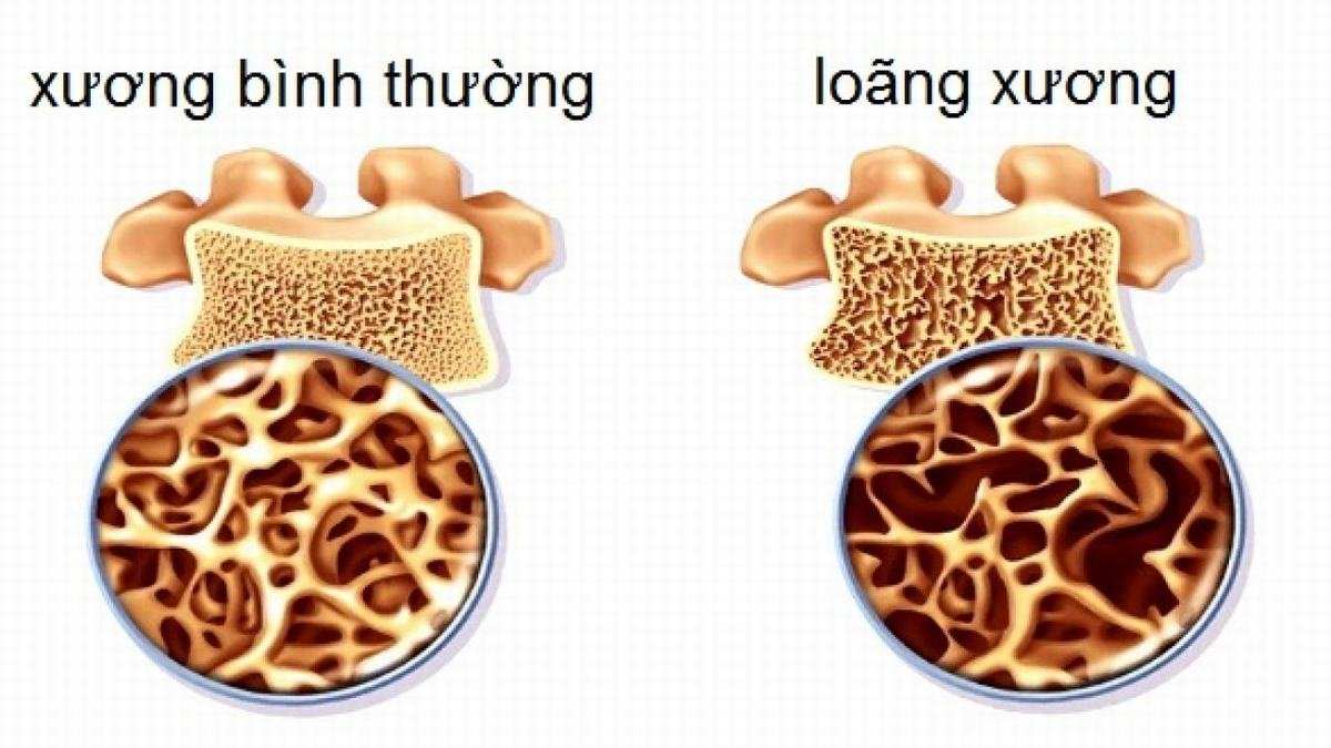 Sự khác nhau giữa xương bình thường và loãng xương